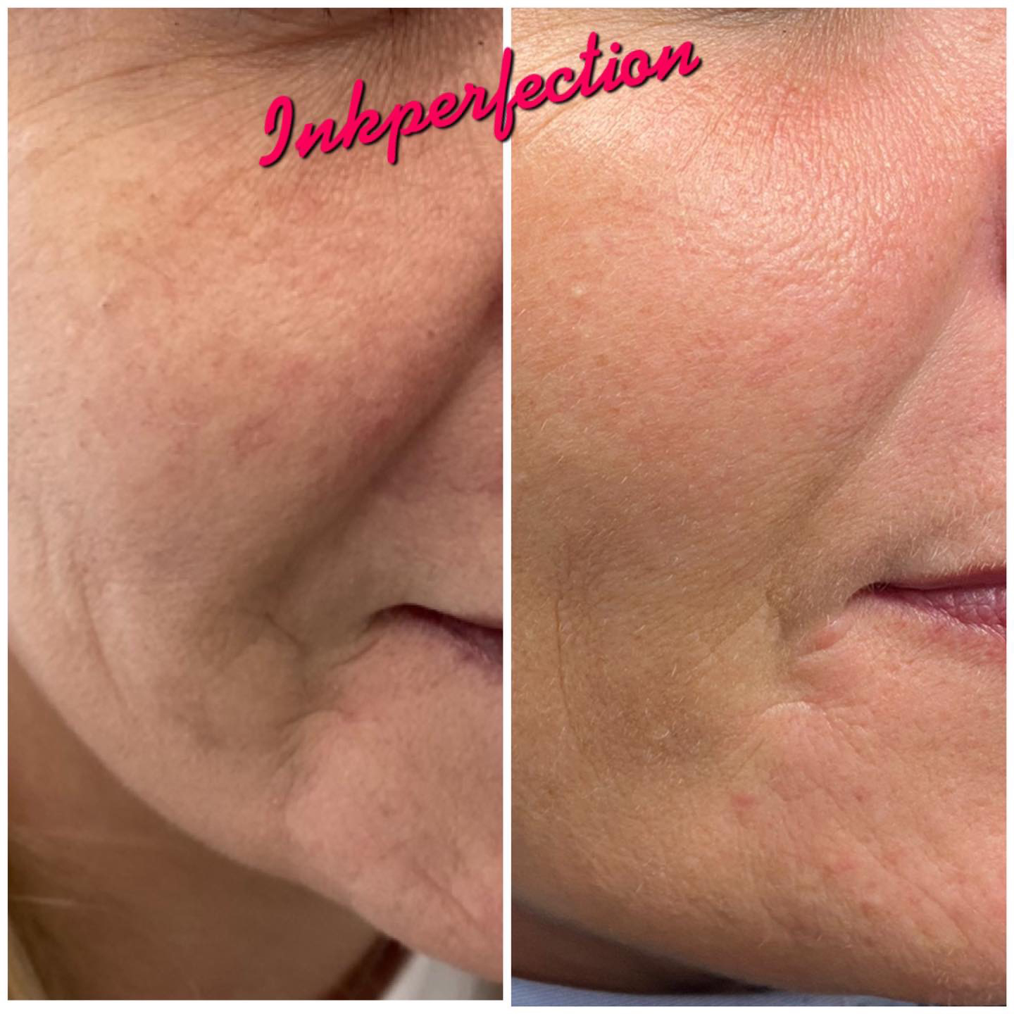Skin Booster Treatments Outwood