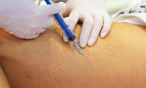 Threat vein Treatment Experts Wakefield