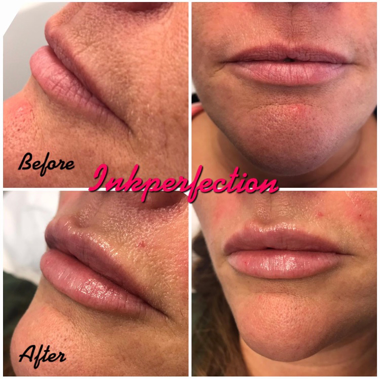 Dermal Filler Treatments Alverthorpe