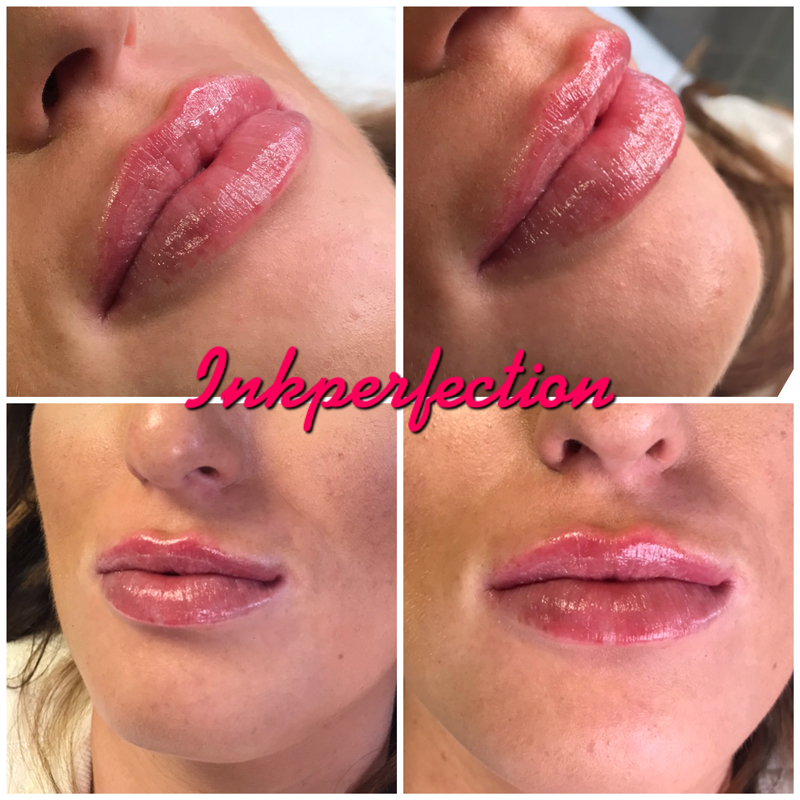 Dermal Filler Treatments Stanley