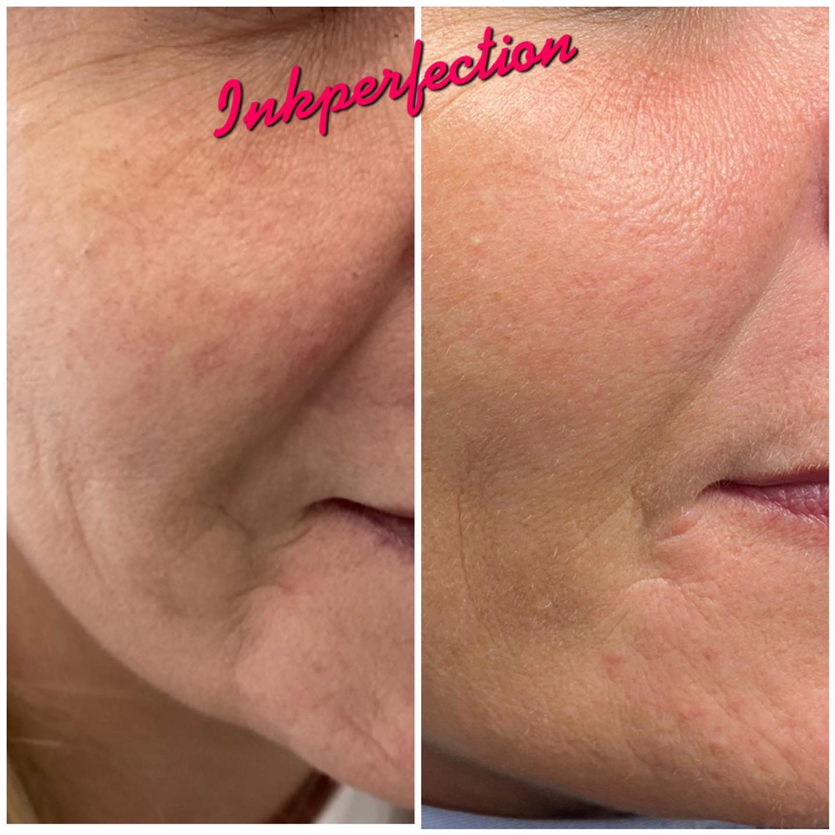 Skin Booster Treatments alverthorpe
